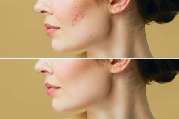 pele feminina com acne