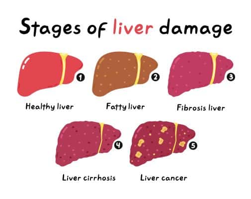 Estágios das doenças no fígado